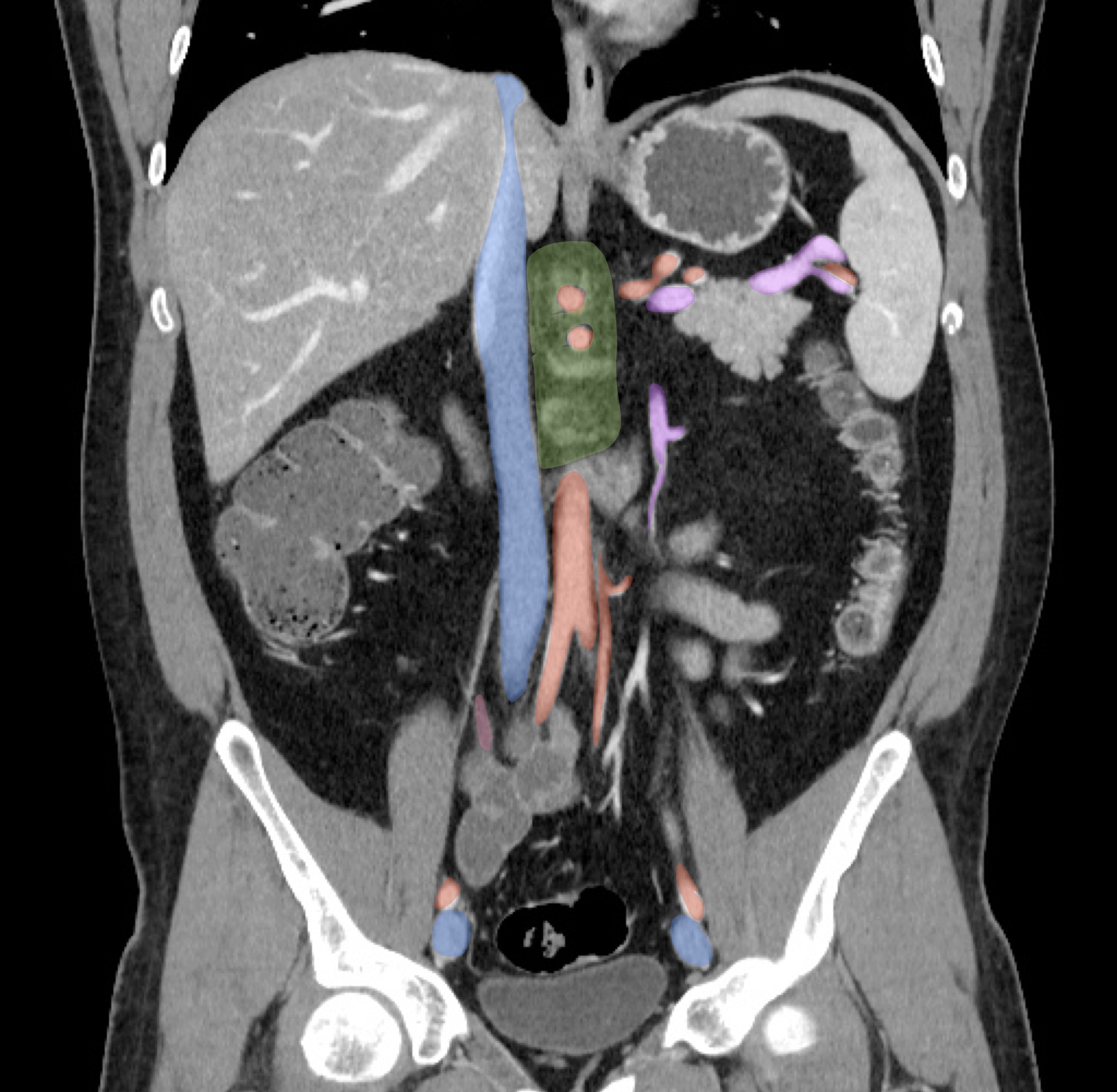 CT Annotation